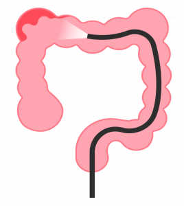 大腸疾患イメージ